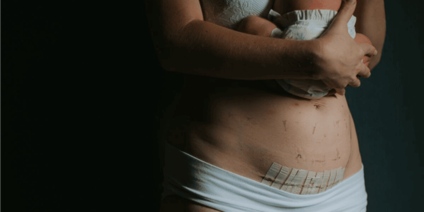 Why I don’t want to call my C-Section a ‘Belly Birth’ mom showing c-section or belly birth scar