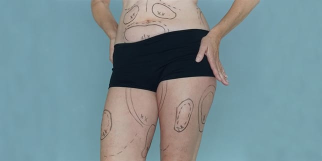 I’m Thinking About Plastic Surgery Post-Baby