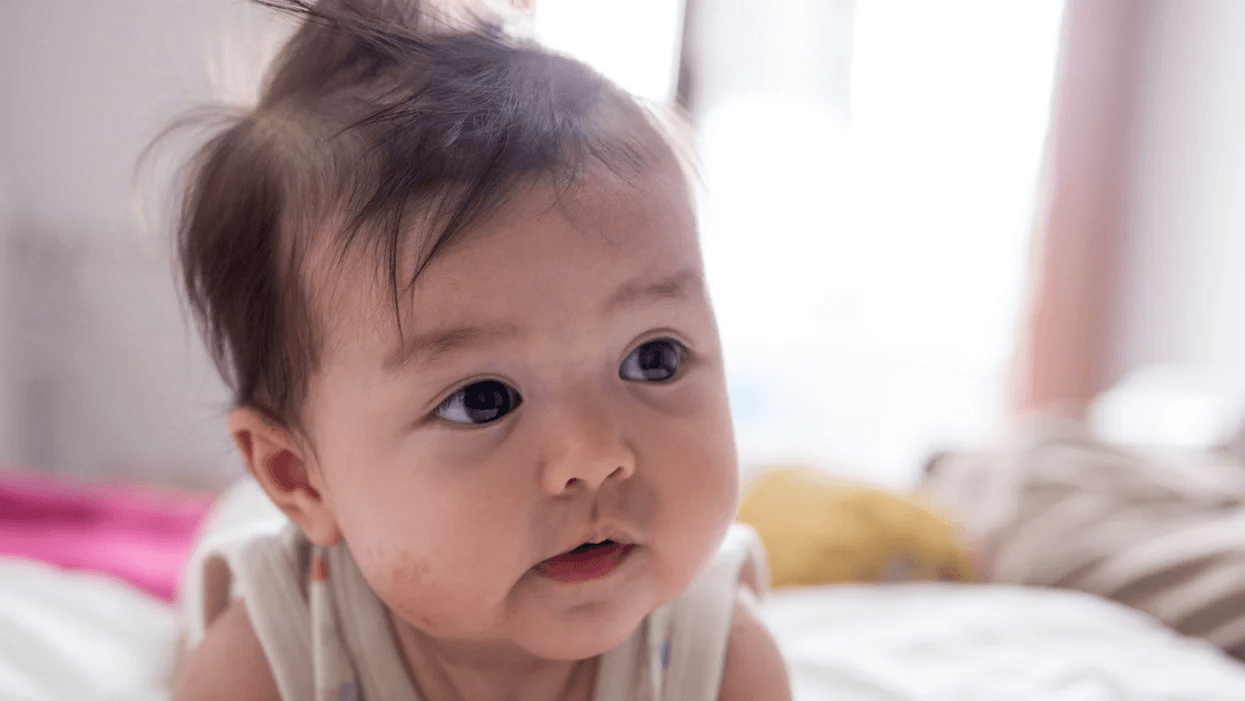 My baby had eczema—here’s what *really* helped baby with eczema on her face