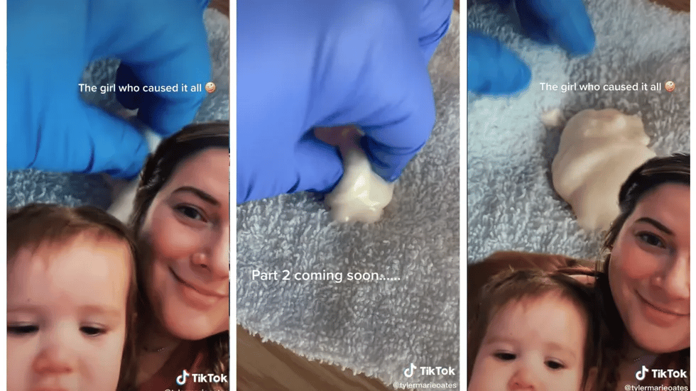 Viral TikTok of clogged milk duct reminds us breastfeeding mamas are champs clogged-milk-duct-screenshot-tiktok