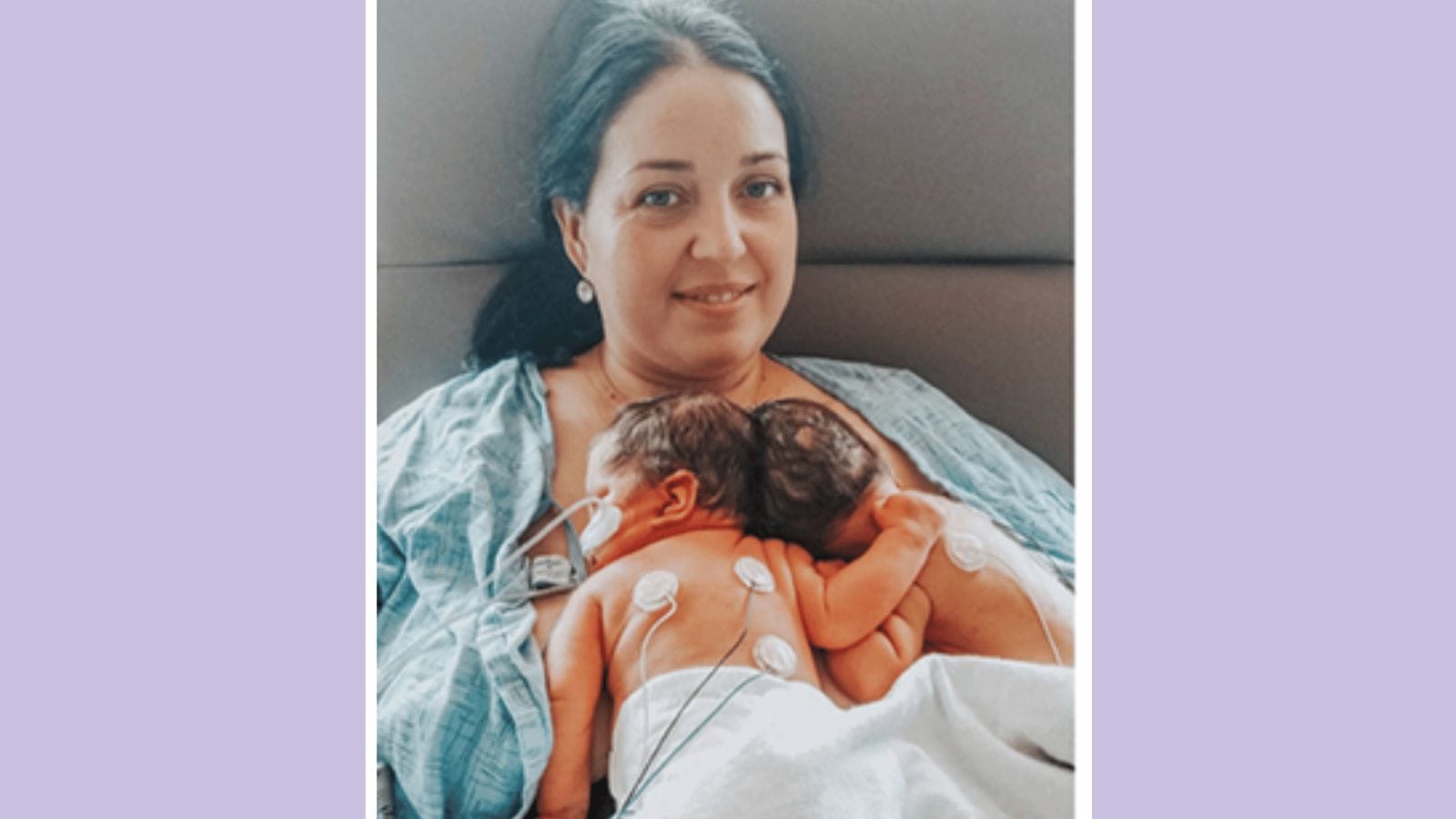 Conjoined twins separated in landmark, 24-hour surgery