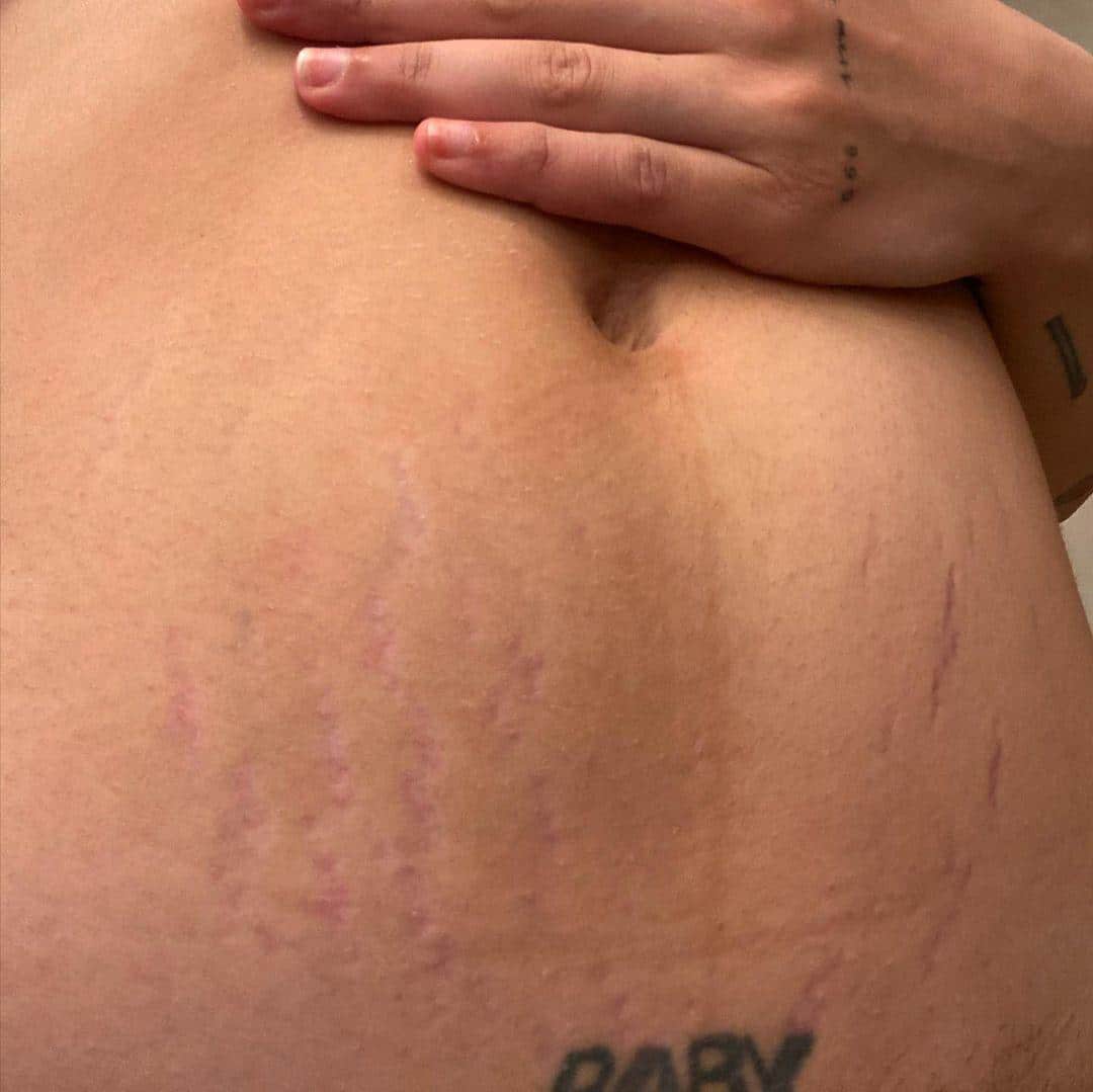 Halsey shares a relatable photo of their postpartum belly
