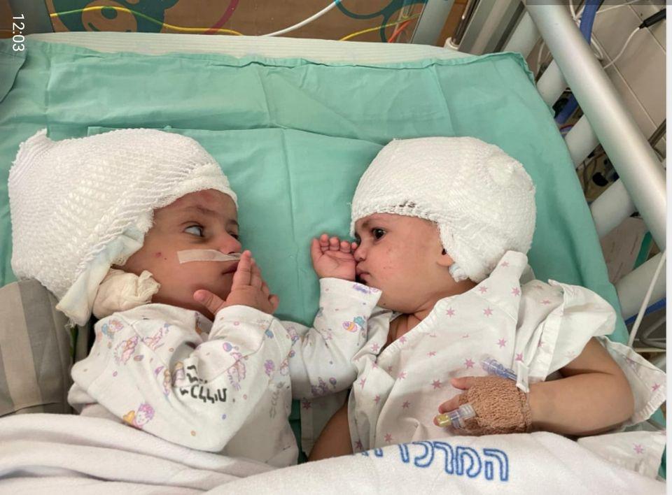 Watch the sweet moment these formerly conjoined twins see each other for the first time