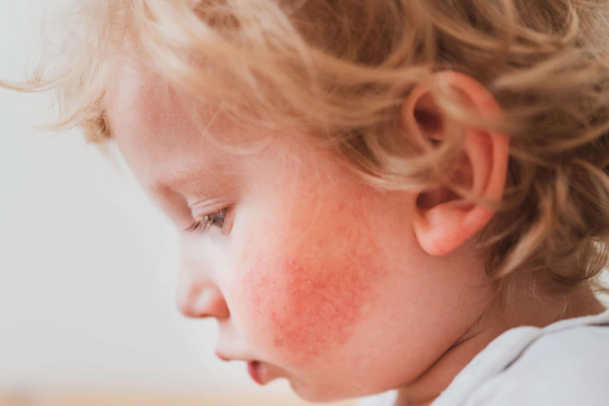 Managing your child’s eczema? A psychodermatologist explains the important link between skin and stress