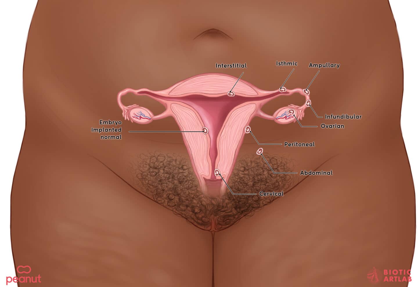Peanut EctopicPregnancy logo skin4 - Motherly