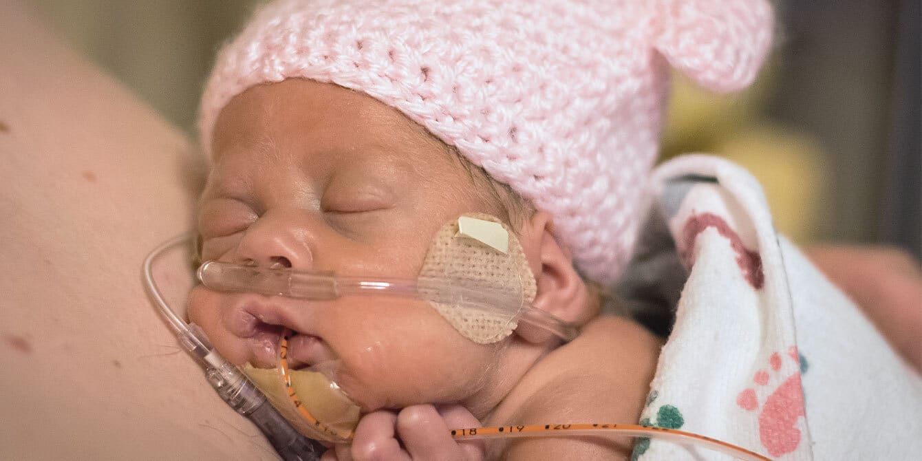 WHO now recommends all premature babies receive immediate skin-to-skin contact after birth premature infant sleeps on mother's chest while practicing skin-to-skin contact after birth