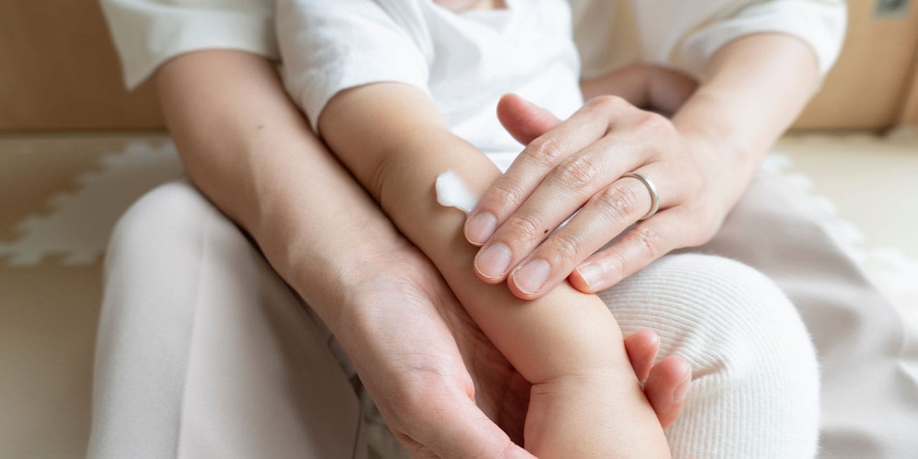 How to treat your child’s eczema parent putting cream on baby's skin in eczema treatments for kids