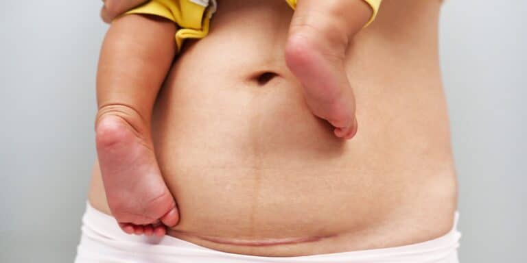 To my C-section scar: I hate you and I love you mom holding child with belly showing c-section scar- my c-section scar