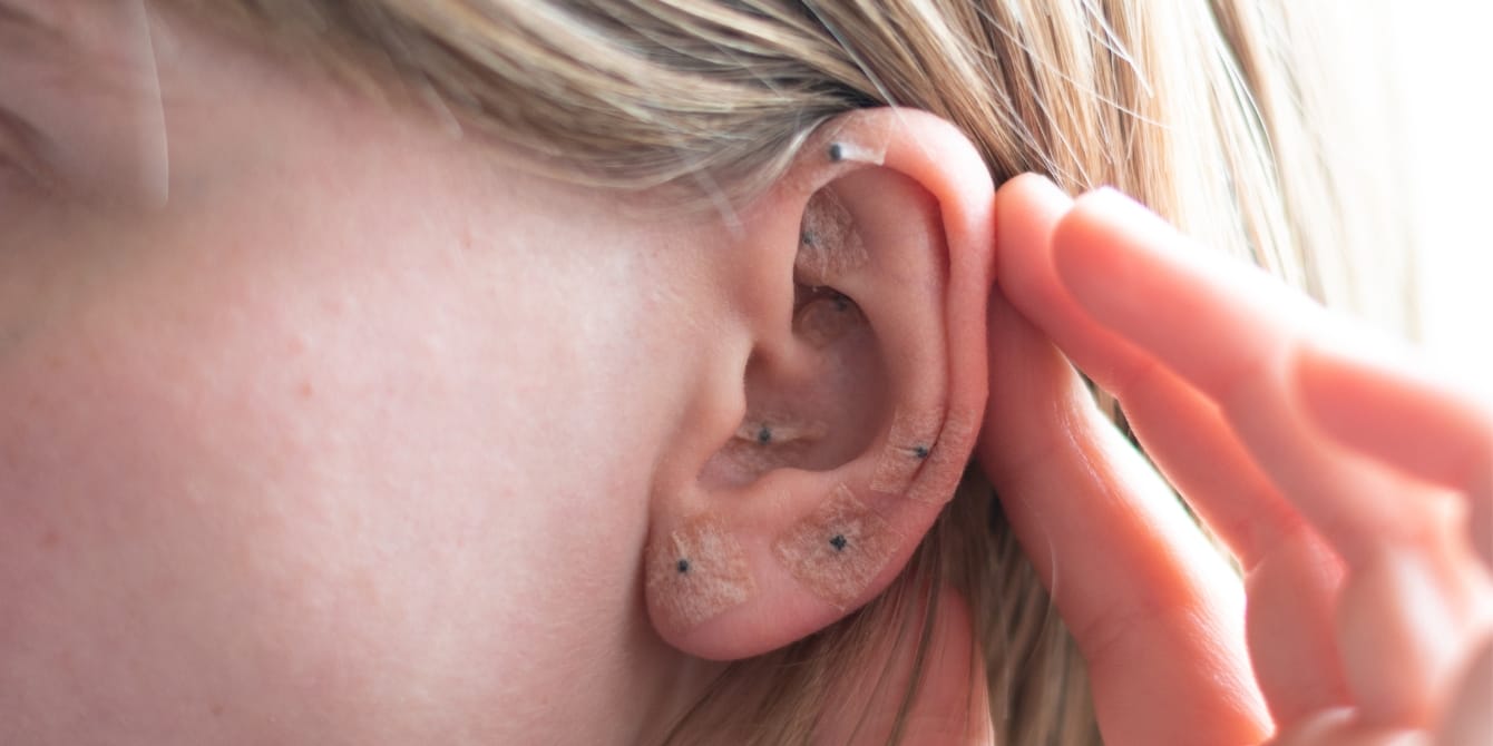 Should you try ear seeds for morning sickness? woman shows acupuncture on the ear - ear seeds for morning sickness