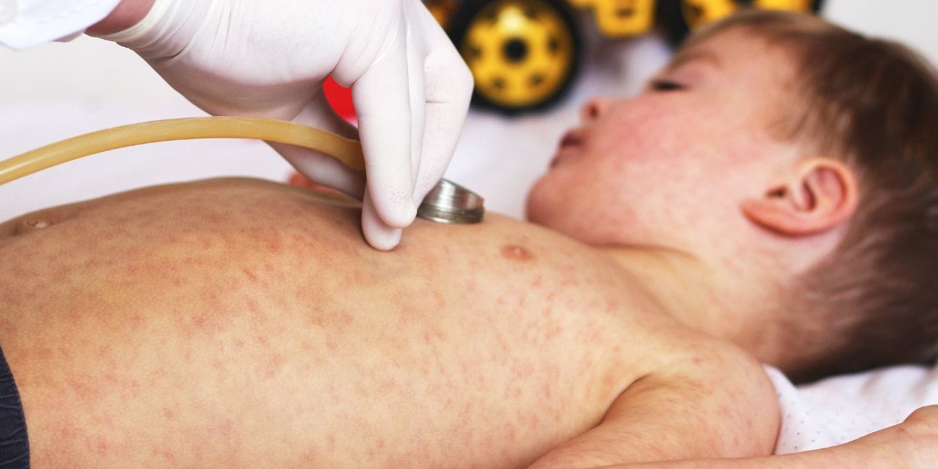 Measles outbreaks have been reported in multiple states, AAP says child with measles at doctor's office - measles outbreak in multiple states