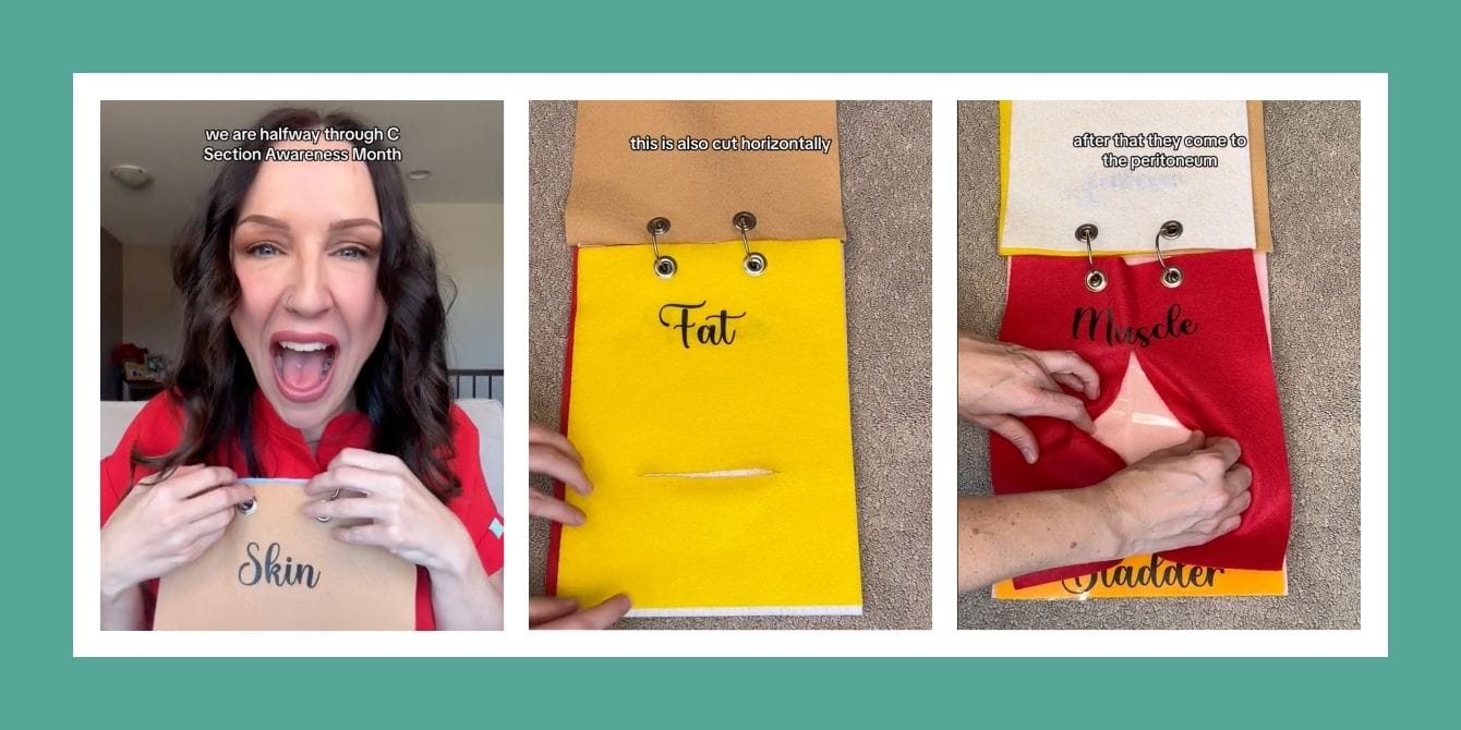 Viral TikTok shows all the layers a C-section has to go through—and how they’re cut Viral TikTok showing all the layers of a C-section