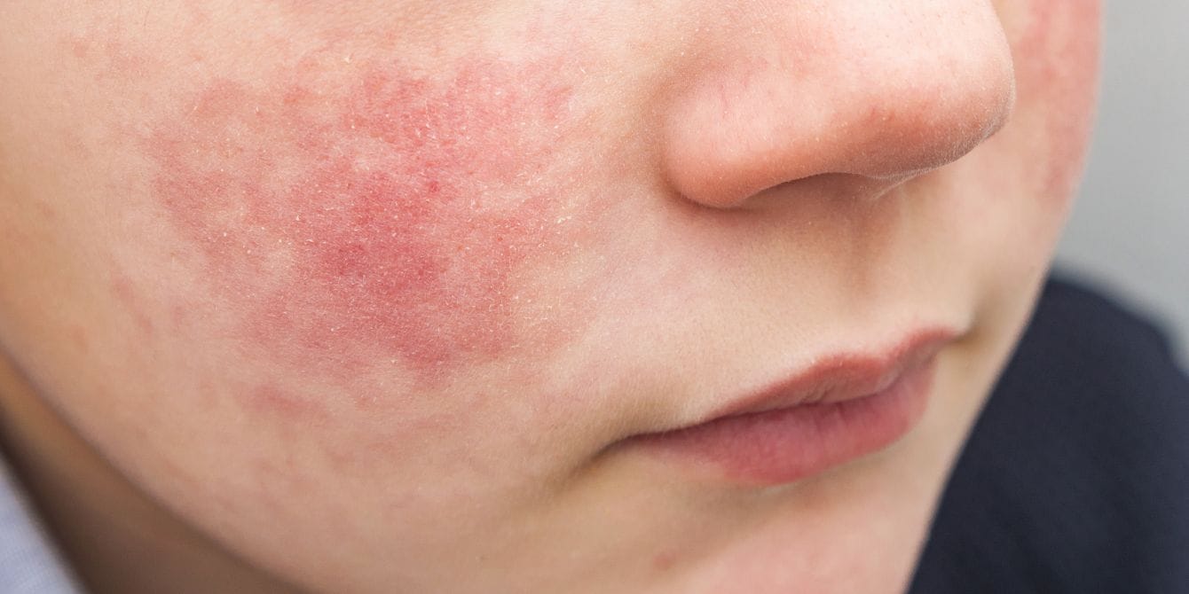 CDC warns cases of Fifth disease are on the rise in kids ages 5 to 9 boy with red cheeks - fifth disease cases rising
