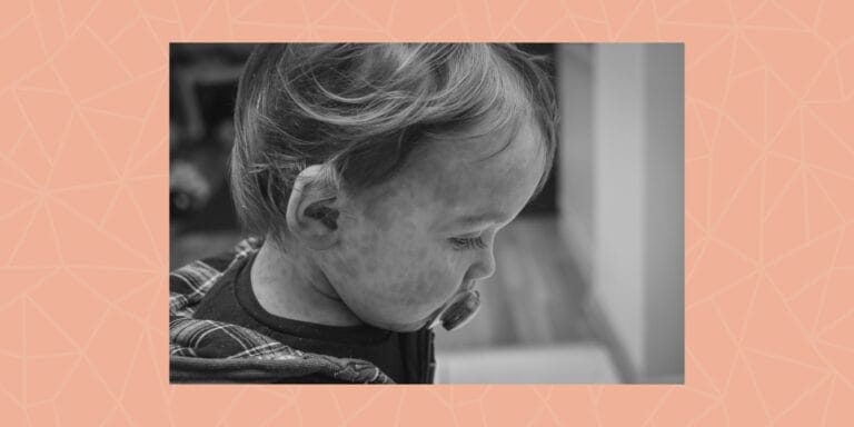 Measles outbreak: What parents need to know to keep their kids safe A baby with measles