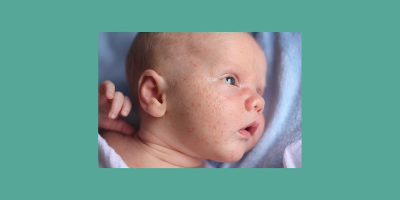 Yes, baby acne is real—and more common than you think baby acne